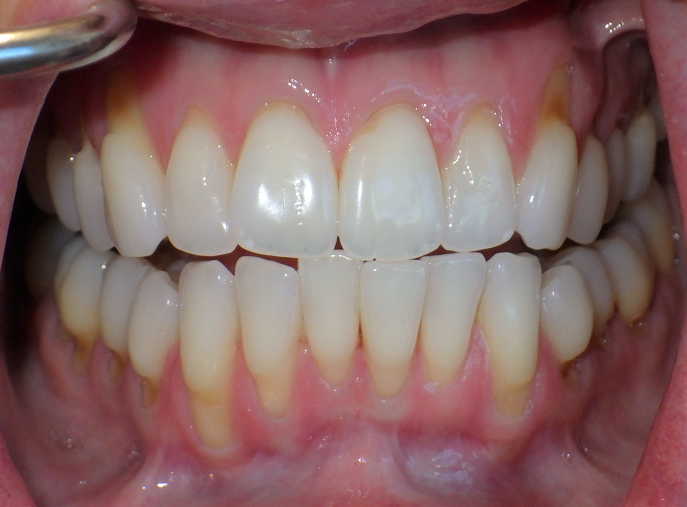 Before
